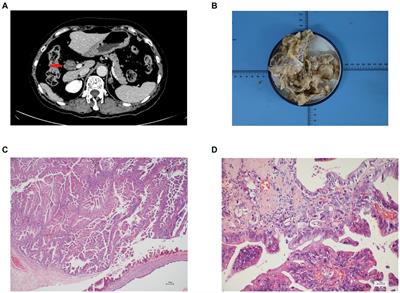 Clinicopathological features and surgical treatments of intraductal papillary neoplasm of the bile duct: a case report and literature review